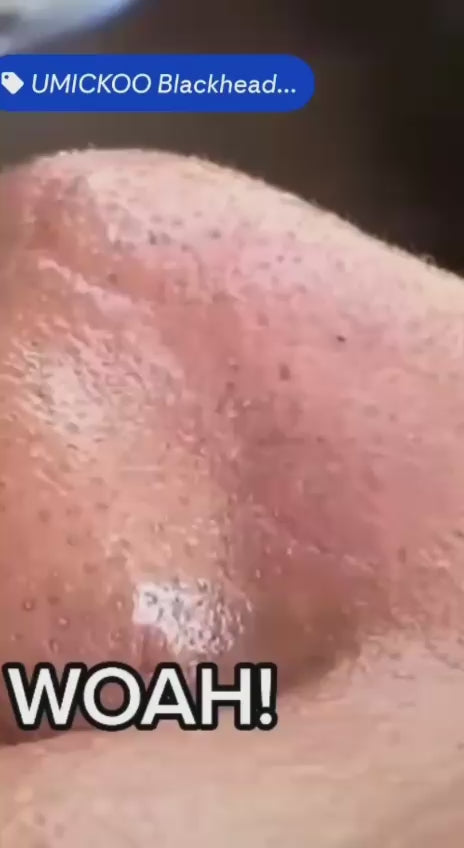 Black Head Remover Skin with 5 Tips